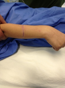 20 de noviembre 2012: Preoperatorio.Cicatriz previa, Se muestra extensión activa de muñeca y dedos de la mano derecha